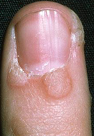 Wart on the nailbed